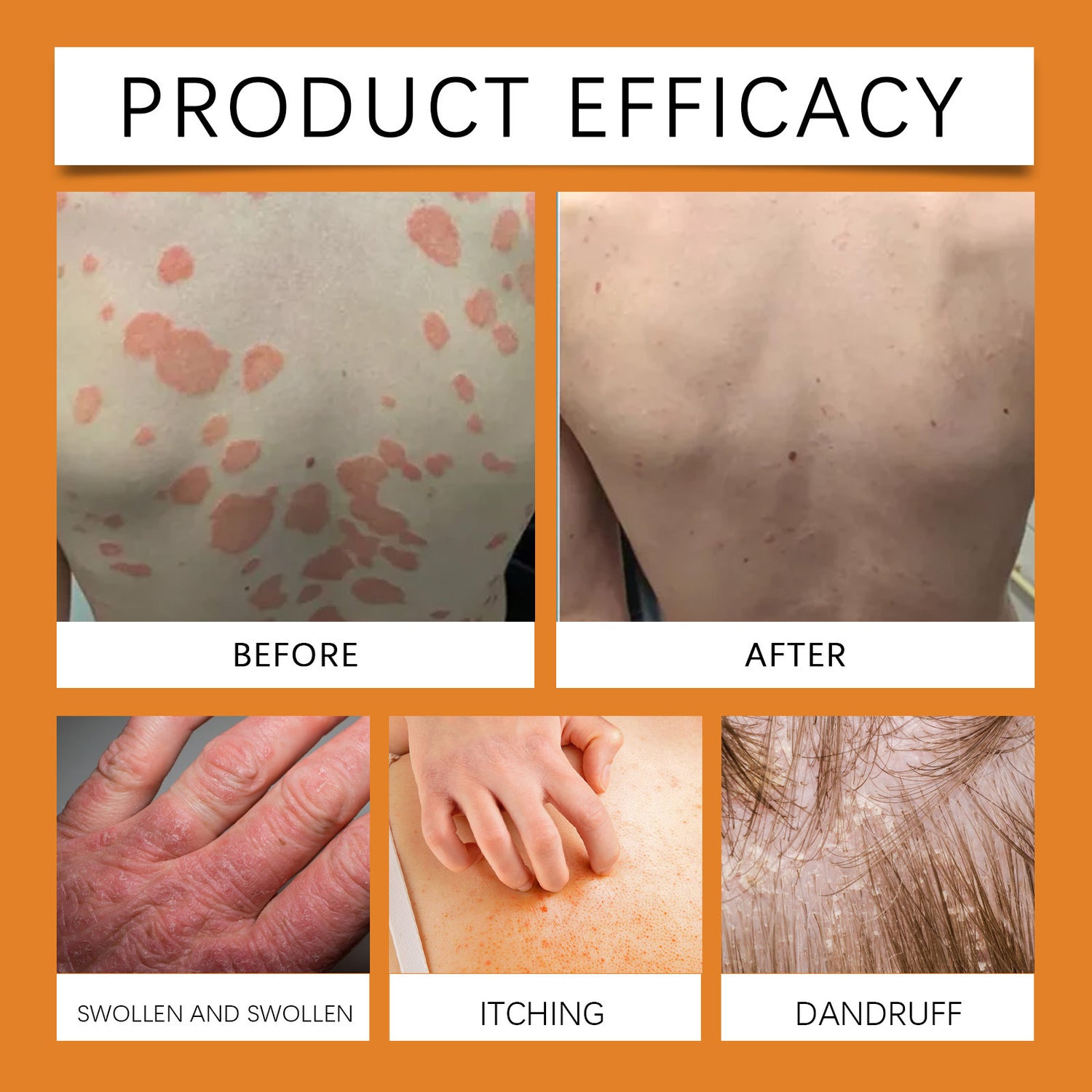 Bee venom psoriasis care cream tube held next to a dry flaky patch of skin