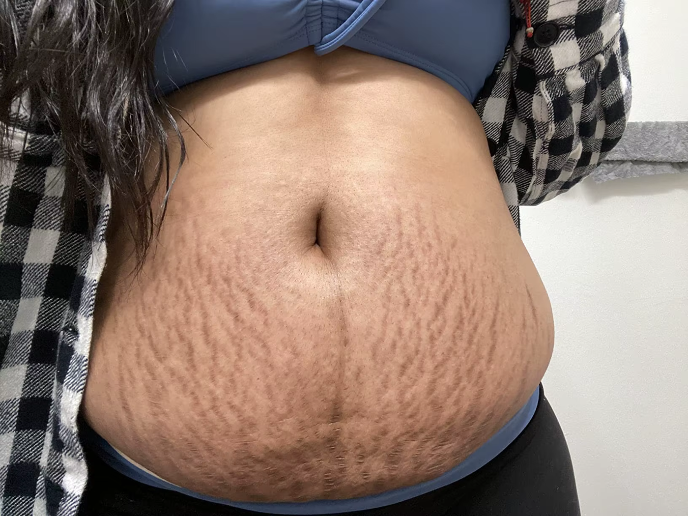 stretch-mark-cream-body-skin-repair customer review photo 10