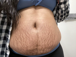 stretch-mark-cream-body-skin-repair customer review photo 10