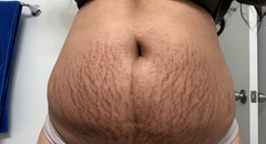 stretch-mark-cream-body-skin-repair customer review photo 10