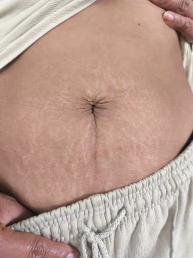 stretch-mark-cream-body-skin-repair customer review photo 13