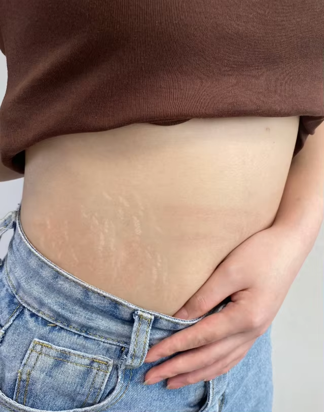 stretch-mark-cream-body-skin-repair customer review photo 14