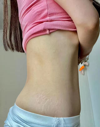 stretch-mark-cream-body-skin-repair customer review photo 16