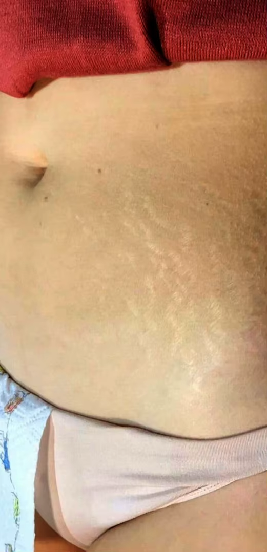 stretch-mark-cream-body-skin-repair customer review photo 18