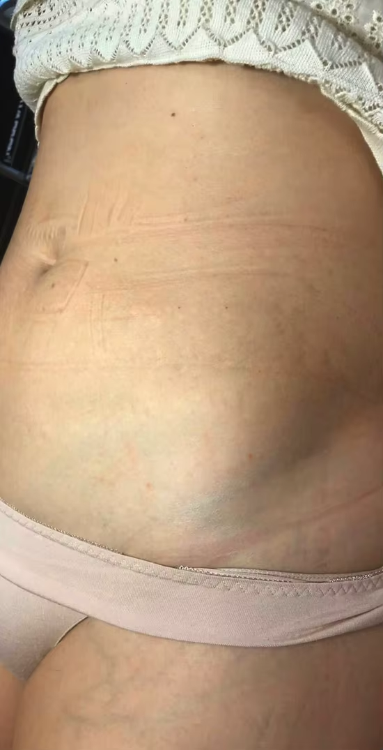 stretch-mark-cream-body-skin-repair customer review photo 18