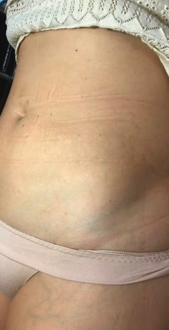 stretch-mark-cream-body-skin-repair customer review photo 18