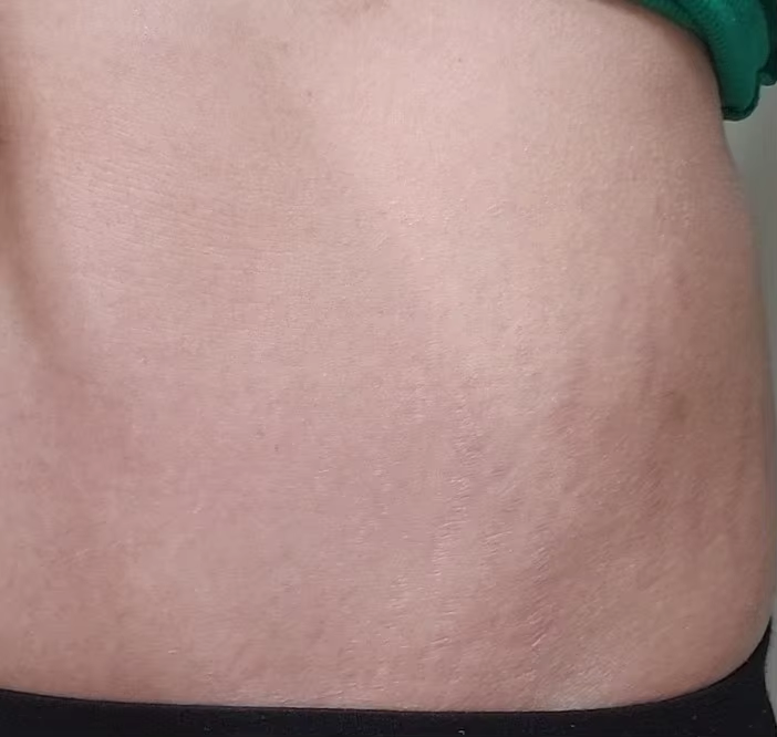 stretch-mark-cream-body-skin-repair customer review photo 19