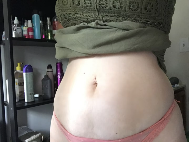 stretch-mark-cream-body-skin-repair customer review photo 4