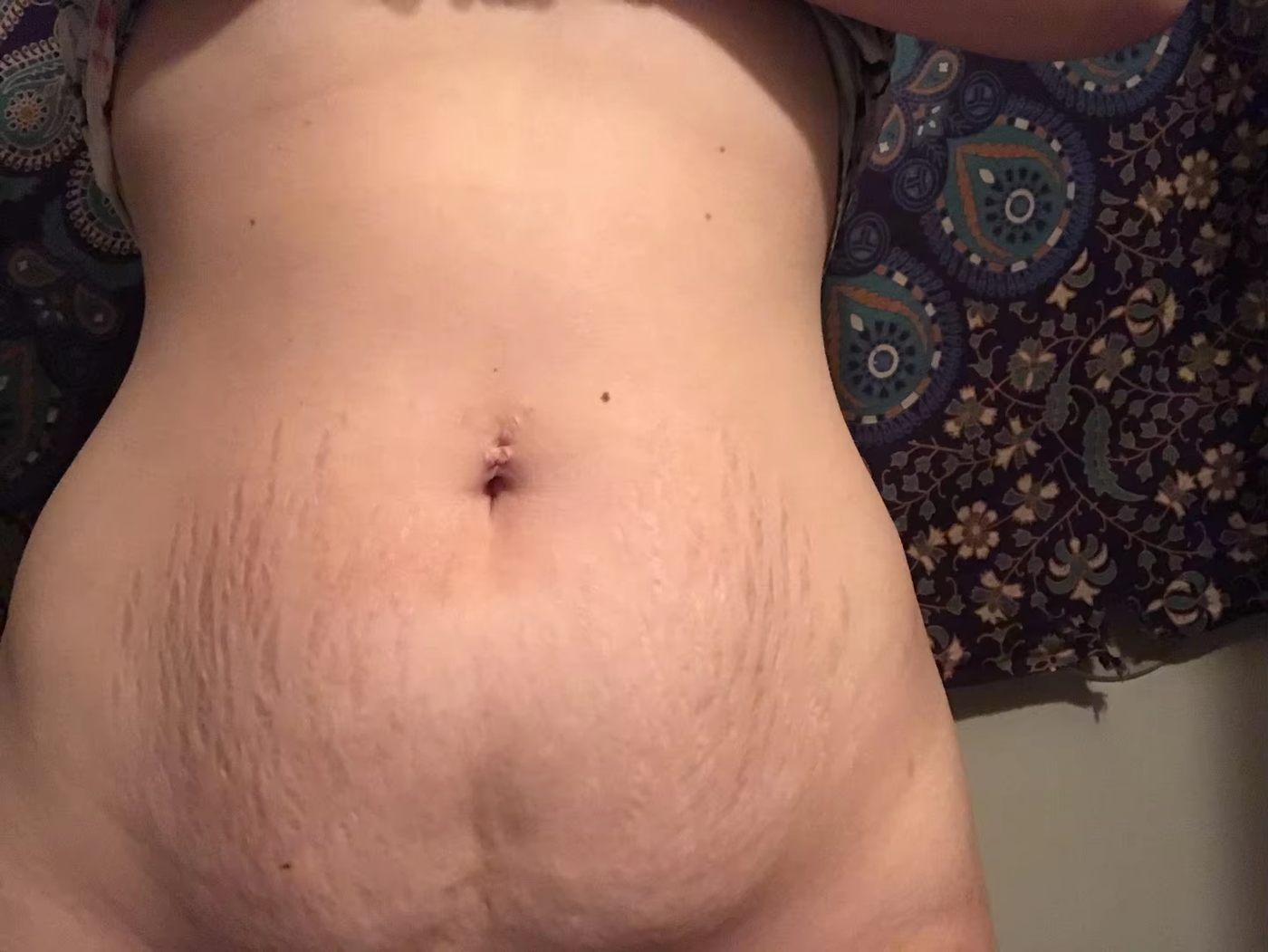 stretch-mark-cream-body-skin-repair customer review photo 4