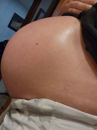 stretch-mark-cream-body-skin-repair customer review photo 5
